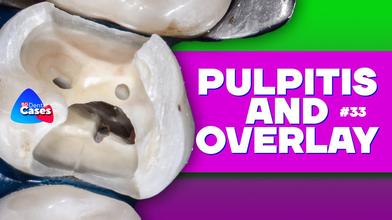 Pulpitis and overlay | BG Dental Cases #33 - YouTube