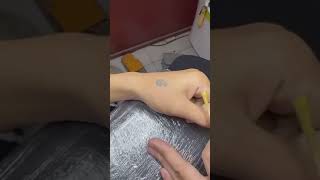 تقنية إزالة الوشم بالليزر - Laser tattoo removal