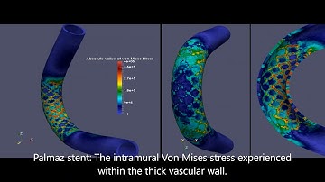 Fluid structure interaction modeling of coronary stent using Finite element method