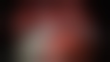 Robotic Simple Prostatectomy for BPH - Ketan K. Badani, MD - Mount Sinai Urology Department