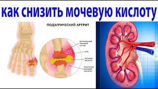 Как лечить приступ подагры. Как снизить уровень мочевой кислоты