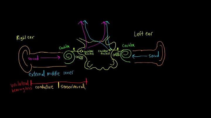 Schneid Guide to Lesion localization for Unilateral Hearing Loss