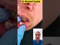 Read my lips dr khaled sadek cystremoval shorts