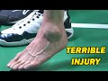 Terrible injury in badminton  badminton restore