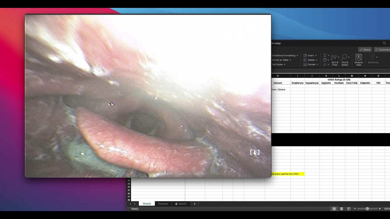 How to rate FEES using VASES in clinical practice YouTube