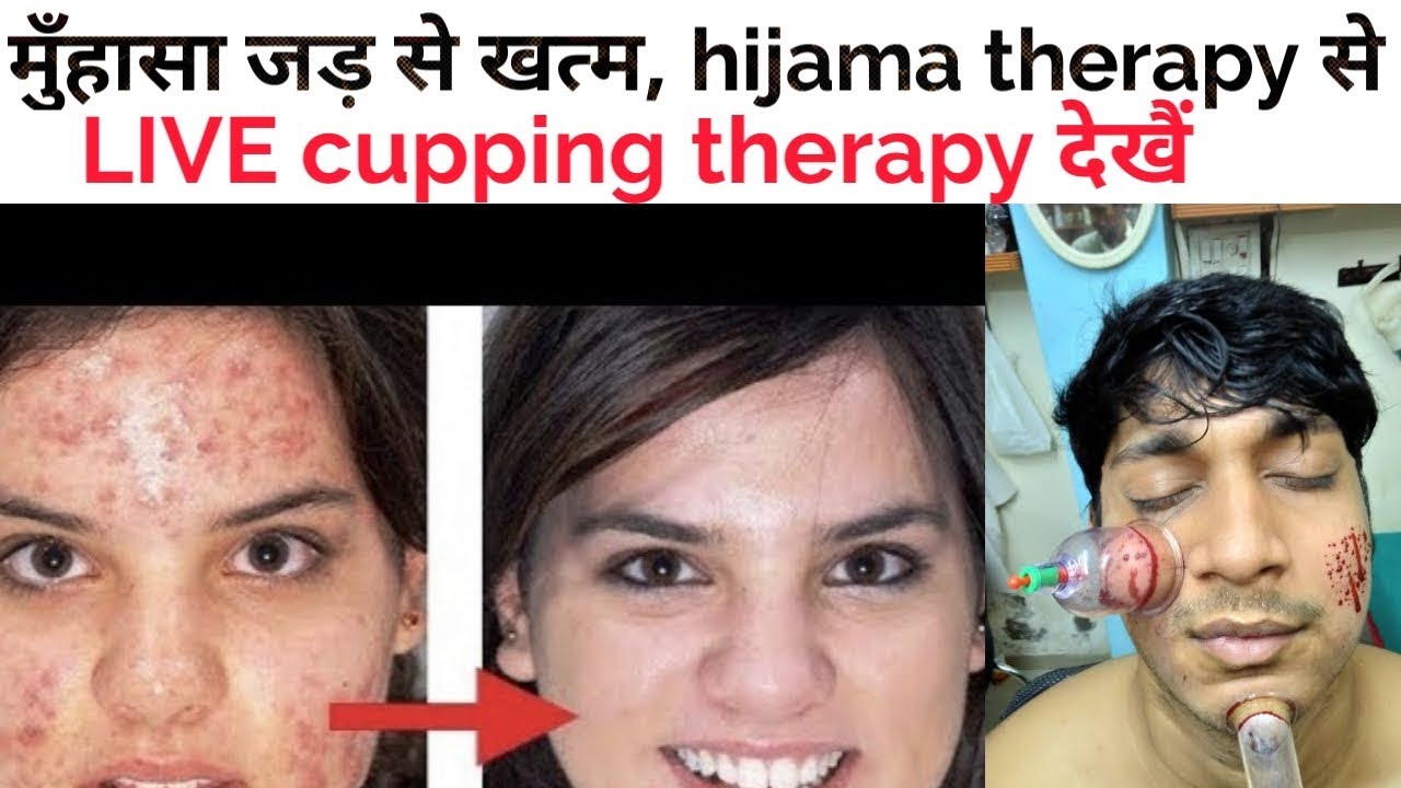 मुँहासा जड़ से खत्म होगा HIJIMA cupping therapy से, LIVE face Hijama cupping therapy देखे.....