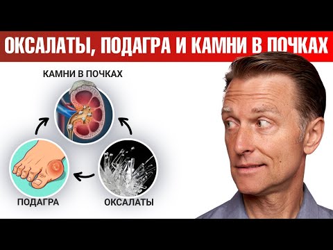 Подагра и камни в почках 👉 как решить проблему с оксалатами?