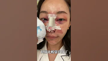 整形一個月恢復 福爾思庭 