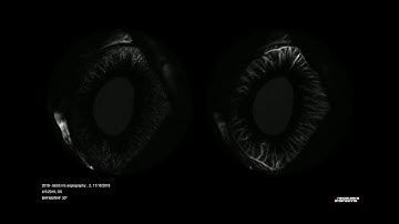 Iris Fluorescein Angiography