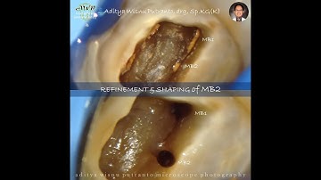 Step by Step of MB2 Refinement & Shaping - Endodontic Treatment