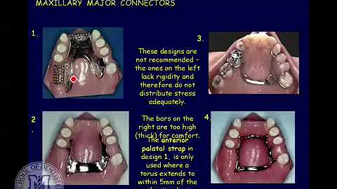 DENT 718: Classification and components of removable partial dentures