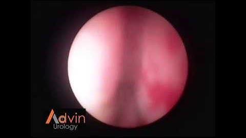 Advin Lithotripter Digital Video