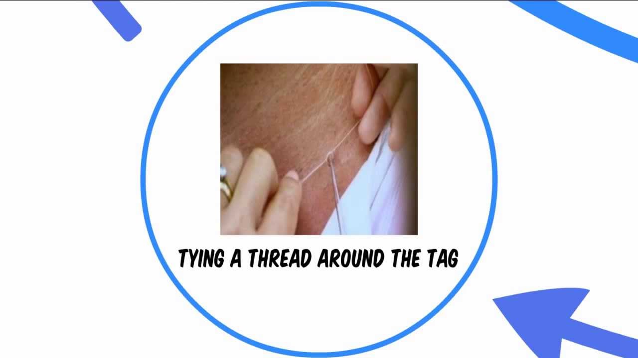 How To Remove A Skin Tag Home Remedies For Skin Tags