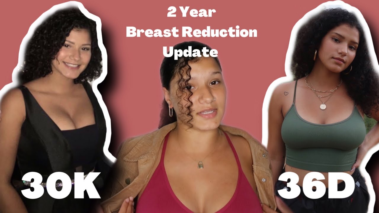 2 Year Breast Reduction Update!