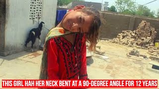 This Girl Hah Her Neck Bent at a 90-Degree Angle for 12 Years. The Story of Afsheen Gul