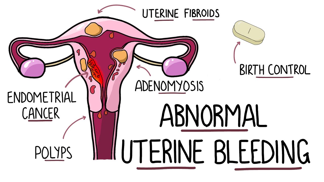 Abnormal Uterine Bleeding (Aub) - Menorrhagia  Heavy Menstrual Bleeding | (Including Mnemonic!)