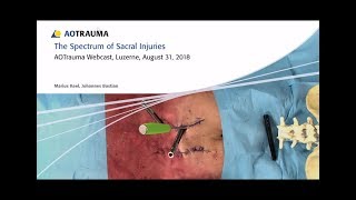 The Spectrum of Sacral Injuries - AOTrauma Webcast screenshot 2