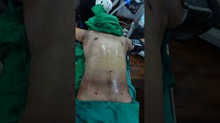 Gynecomastia Surgery | Gynecomastia Surgery cost | Gynecomastia Surgery Video