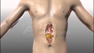 Download lagu Open abdominal surgery
