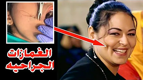 شاهد كيف يتم عمل الغمازات بالجراحه Industrial Dimple Surgery شاهد كيف يتم عمل الغمازات بالجراحه Industrial Dimple Surgery