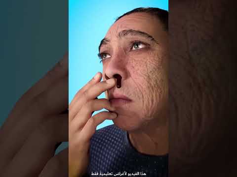 الطريقة الصحيحة لإيقاف نزيف الأنف 