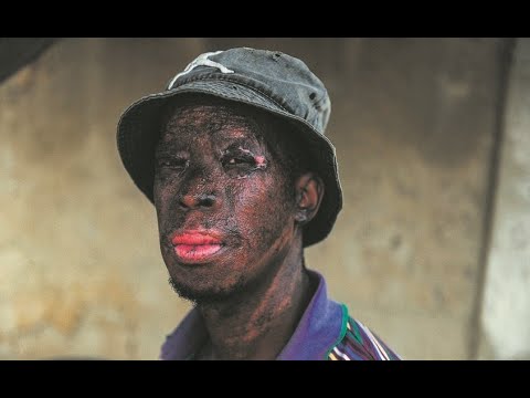 Zikhaya Sithole, a Hero Who Got Burned While Trying to Save Two Kids