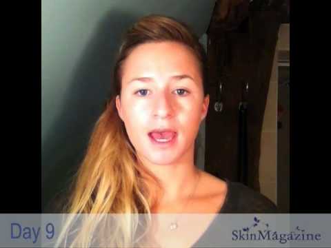 Sophie Video Diary using Sliver Serum for Acne