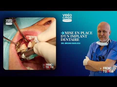 Se puede fumar si te hacen un implante