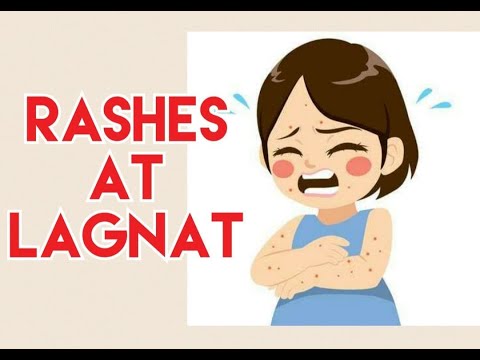 Video: Rash sa balat sa anyo ng mga red spot na may pangangati sa mga matatanda