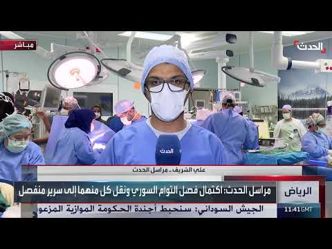 فصل توأمين سياميين بعد عملية جراحية في المملكة