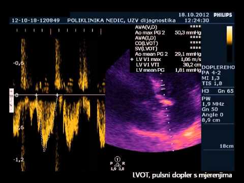 Video: Aortálna Stenóza - Príznaky, Stupne, Liečba