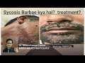 Repeated infection of beard areadadhi me bar bar infection ka karan aur ilazdr uttam kumar lenka