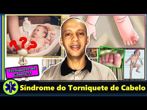 Vídeo: Torniquete De Cabelo: O Que é, Sintomas, Fotos E Tratamento