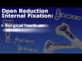 Wrist Fracture - Open Reduction and Internal or External Fixation