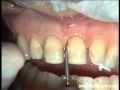 Ceodont Estética Dental: Carillas de porcelana. Tallados - Malposiciones