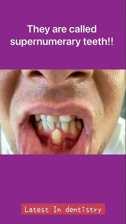 is-it-possible-to-have-more-than-32-teeth-youtube