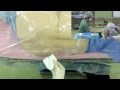 Epidural Catheter Placement by Dr.EpiCal (for TKA)