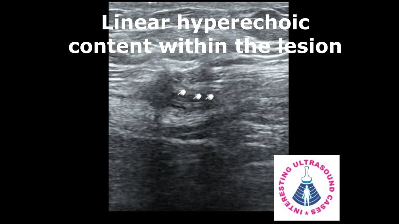 DIFFERENTIATING SCAR ENDOMETRIOSIS AND SUTURE GRANULOMA ON ULTRASOUND