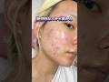 ニキビ肌から褒められ肌になるスキンケアルーティン🫶🏻#shorts #skincare #skincareroutine #スキンケア #スキンケアルーティン #ニキビケア #垢抜け #おすすめ