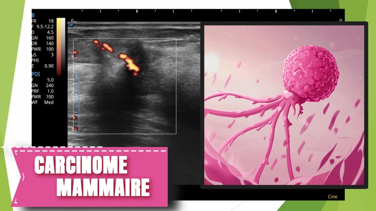 Caractéristiques d'un. cancer mammaire en échographie