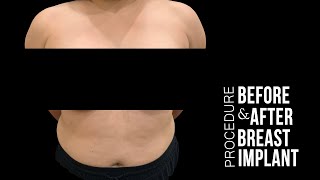 Breast Implants A Cup To D Cup Transformation Della Bennett, Md, Rancho Cucamonga