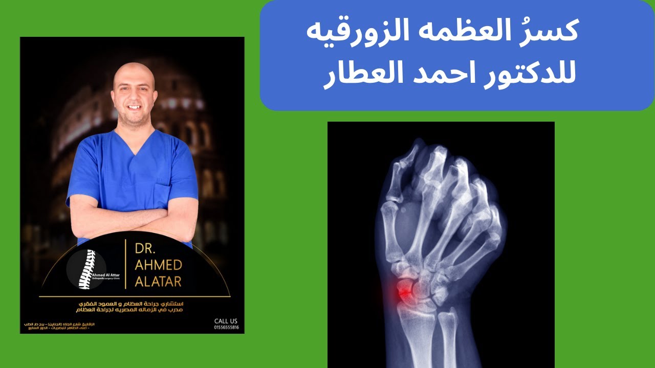 كسرُ العظمه الزورقيه للدكتور احمد العطار