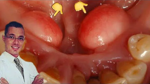 O que pode ser um caroço duro na gengiva?
