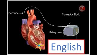 Celebrity Pacemakers and other Cardiac Devices Profile