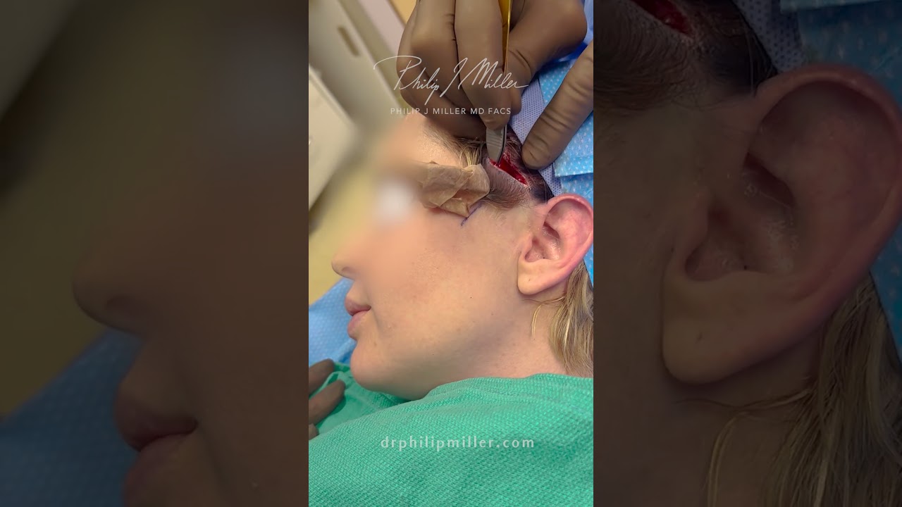 Microlift! Small Hidden Incision Get You Snatched Cheek