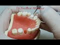 Preparation Of The Upper Premolar PFM
