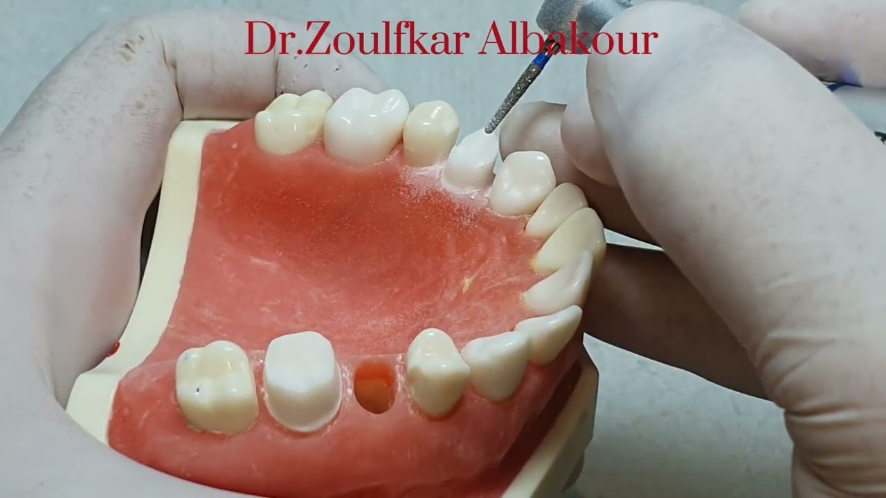 Preparation of the  upper premolar PFM