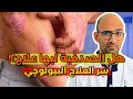 الصدفية اسبابها وعلاجها العلاج البيولوجي للصدفية 