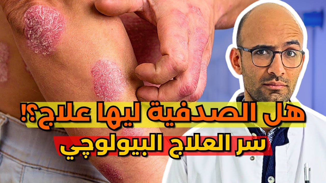 الصدفية - اسبابها وعلاجها - العلاج البيولوجي للصدفية Psoriasis