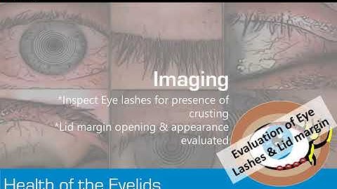 Learning by OCULUS:  My Dry Eye Routine with the Keratograph® 5M